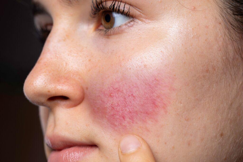Rosacea behandlung Frankfurt_eraesthetic.de